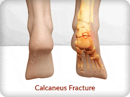 what is calcaneus fracture or broken heel? GIF by ePainAssist