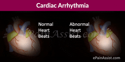 cardiac arrhythmia and the ablation therapy GIF by ePainAssist