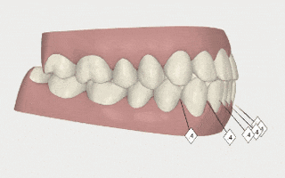 anabelpump invisalign anabel avila anabelpump invisalign study GIF