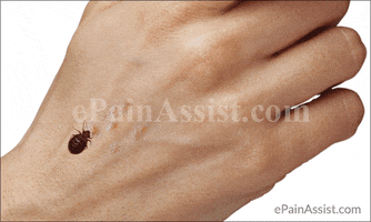 bedbug bite GIF by ePainAssist