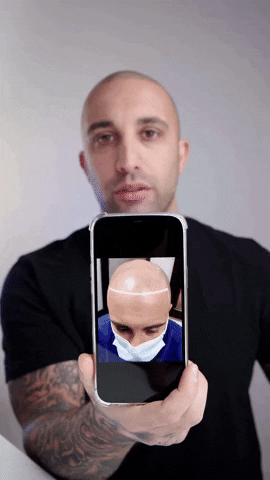 gerowhairink smp hairloss hairline hair tattoo GIF
