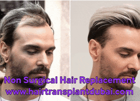 Hair Replacement GIF