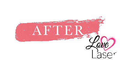 Laser Hair Removal Sticker by Love Laser