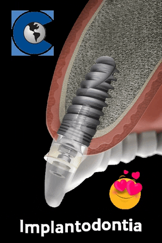 conexaosistemasdeprotese tooth dente conexao implant GIF