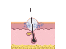 How Acne Appears GIF