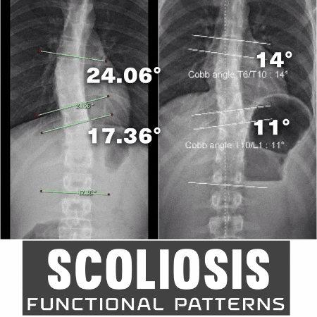 Scoliosis GIF by functionalpatterns