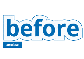 Acne Treatment Sticker by Aerolase