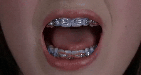 Braces Teeth GIFs - Get the best GIF on GIPHY