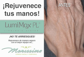 polka #lumimaxrf #rejuvenece #manos #piel #belleza #monissimaloscabos #manchas GIF