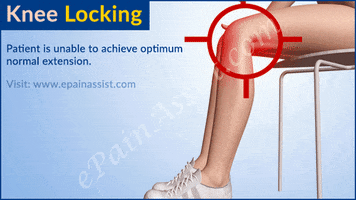 knee locking: what can cause your knee to get locked? GIF by ePainAssist