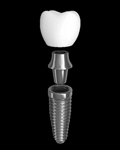 NMQueiroz giphygifmaker dentista dentistry implant GIF