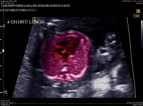 asugarhigh giphyupload heart baby anatomy GIF