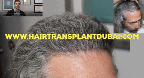 abiaamir giphygifmaker healthcare hair transplant GIF