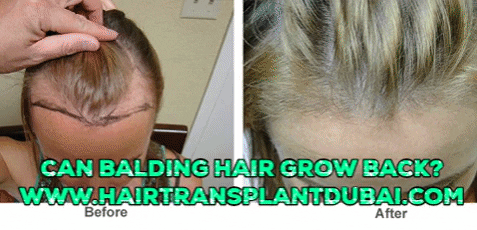 abiaamir giphygifmaker beauty health hair loss GIF