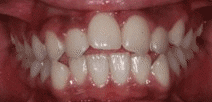 POS_Ortho smile teeth pos before and after GIF