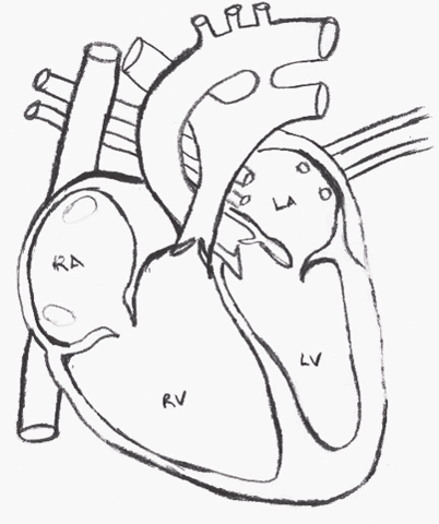 heart defect patent ductus arteriosus GIF