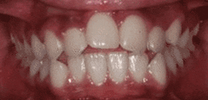 POS_Ortho giphyupload smile teeth pos GIF