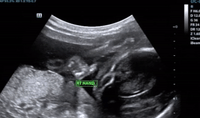 Unborn Baby Appears to Make 'Rock On' Gesture in Ultrasound Video
