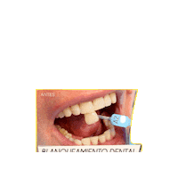 Blanqueamiento Dental Sticker by Centro CEME