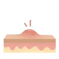 Acne Pimple Sticker by By Lizzie Parra