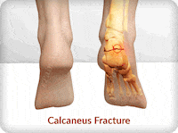 what is calcaneus fracture or broken heel? GIF by ePainAssist