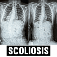 Scoliosis GIF by functionalpatterns