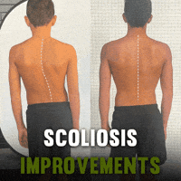 Scoliosis GIF by functionalpatterns