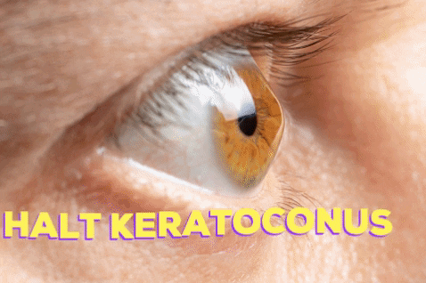 rkmd giphygifmaker cxl intacs keratoconus GIF