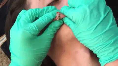 ristoristovski giphyupload face cyst old cyst GIF